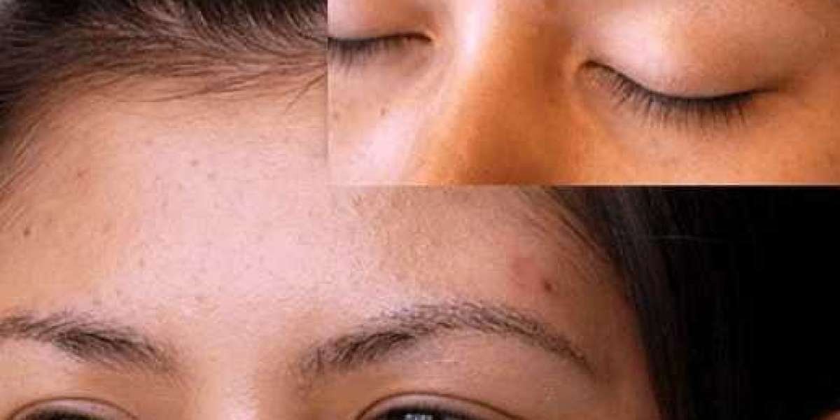 Eyebrow Restoration Treatment