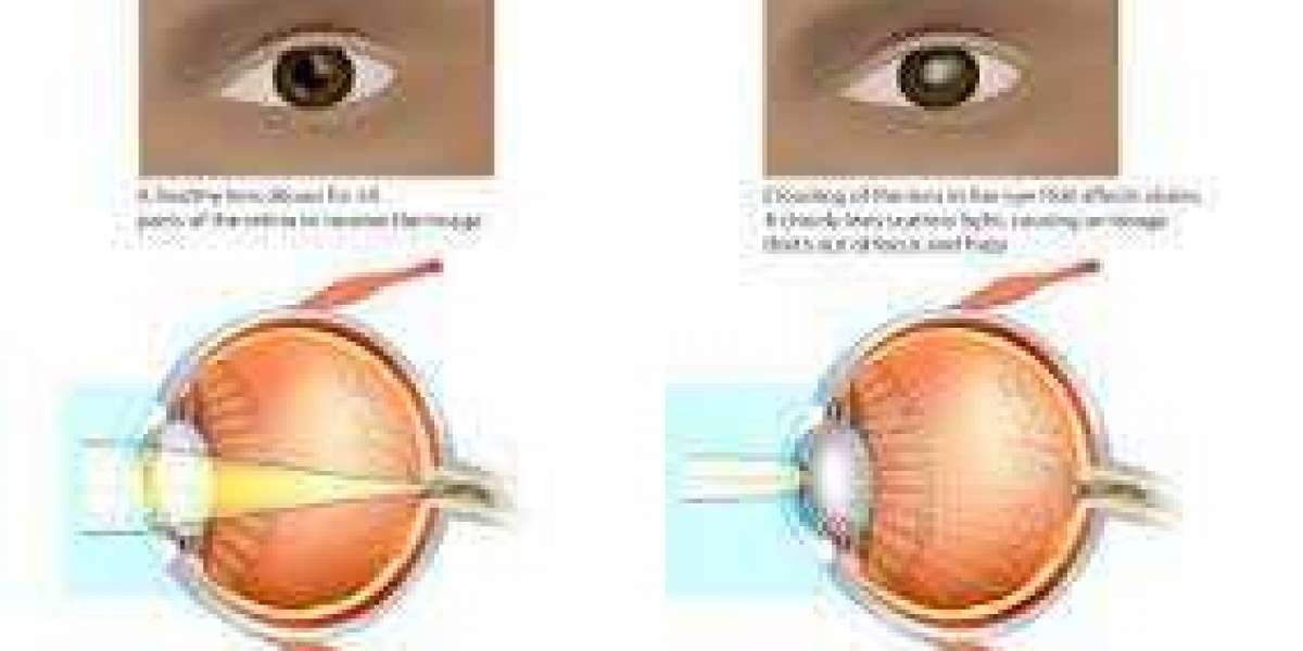 Best Cataract Eye Surgery | Bharti Eye Foundation